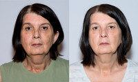 pirottebeforeafter