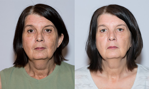 pirottebeforeafter