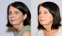 pirottebeforeafter2